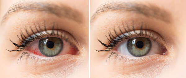 Red eye of woman before and after eyewash treatment