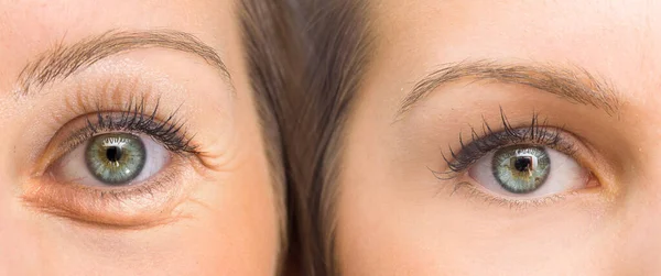 Eyes before and after beauty treatment with and without wrinkles
