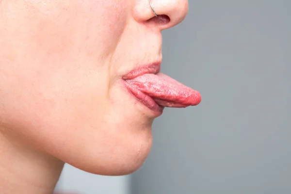 Young Girl Showing Her Tongue Candidiasis Treatment — Stock Photo, Image