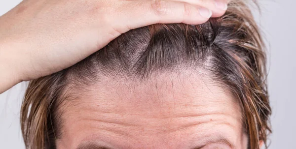 Wrinkles Forehead Man Holding Hair Hand — Stock Photo, Image