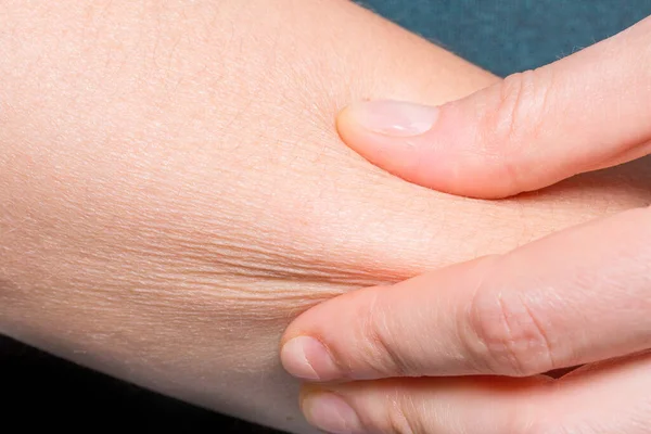 Dedos Apertando Pele Seca Braço — Fotografia de Stock