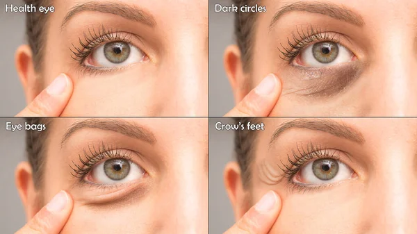 Composición Con Ojo Infernal Círculos Oscuros Bajo Los Ojos Bolsas —  Fotos de Stock