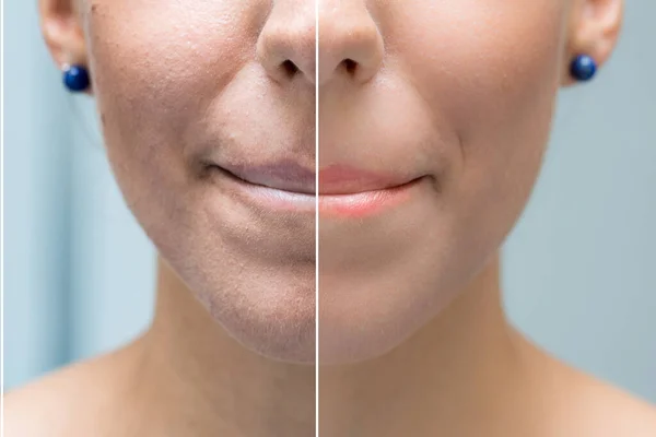 Mujer Cara Antes Después Del Tratamiento Cosmético —  Fotos de Stock