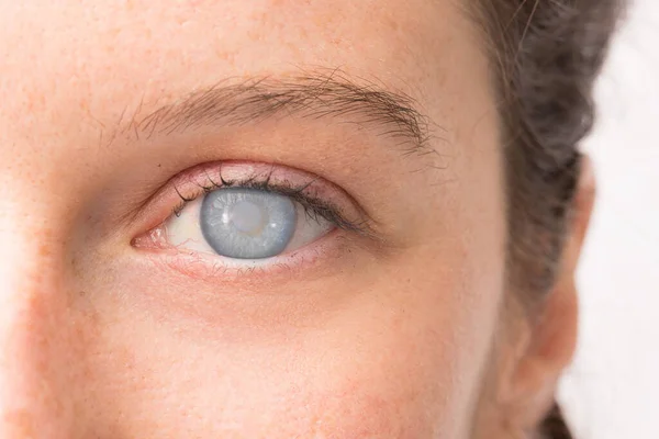 Woman with cataract on eye and corneal opacity