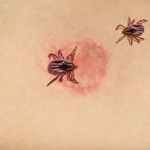 Redness of tick bite