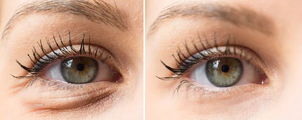 Kozmetik Tedavisinden Önce Sonra Göz Torbaları — Stok fotoğraf