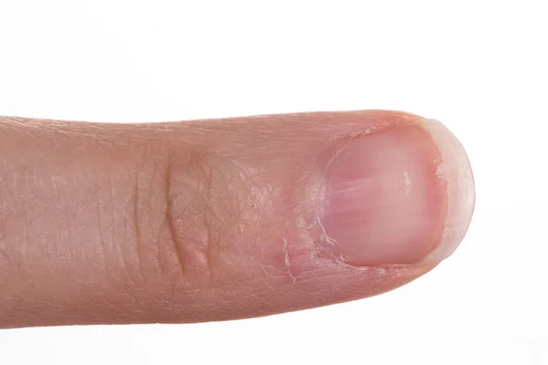 Cuticle Female Nail — Stock Photo, Image