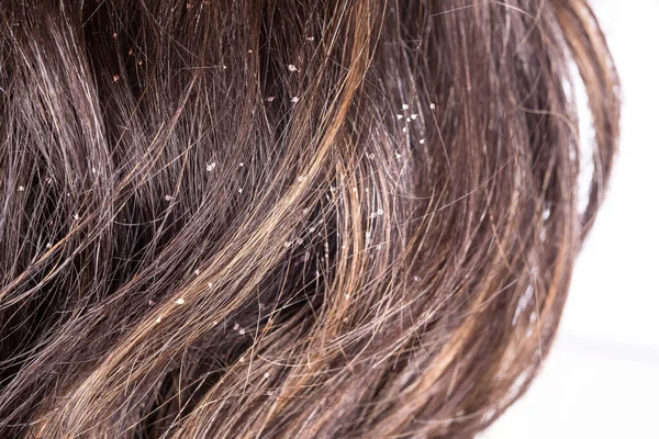 Close Woman Hair Dandruff — Stock Photo, Image