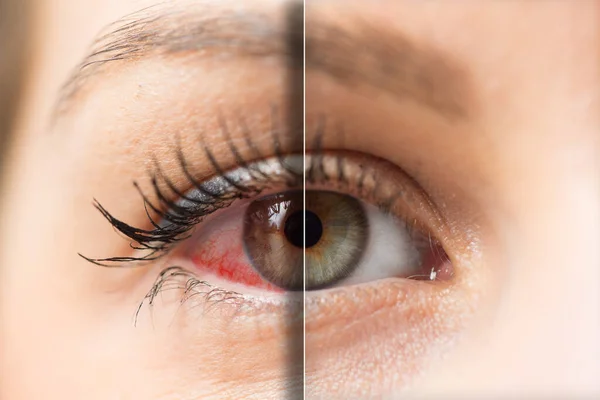 Mujer Ojos Rojos Antes Después Del Tratamiento —  Fotos de Stock