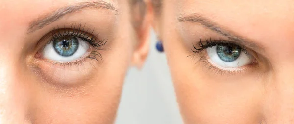 Oko Obrzękiem Bez Obrzęku Przed Zabiegach Kosmetycznych — Zdjęcie stockowe