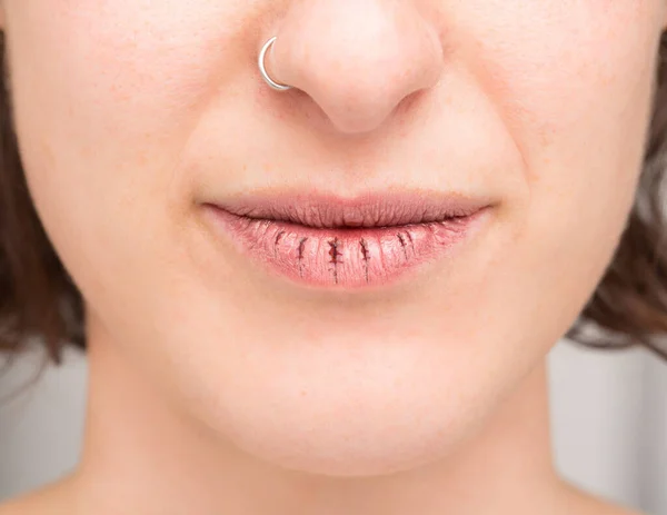 Macro Cracked Dry Lips Young Woman — Stock Photo, Image