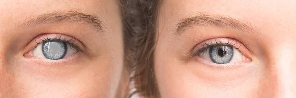 Auge Mit Katarakt Und Hornhauttrübung Vor Und Nach Der Operation — Stockfoto