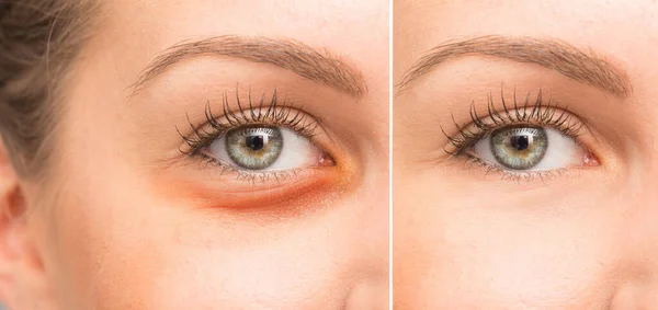 Vor Und Nach Der Blepharoplastik Mit Und Ohne Augenbeutel — Stockfoto