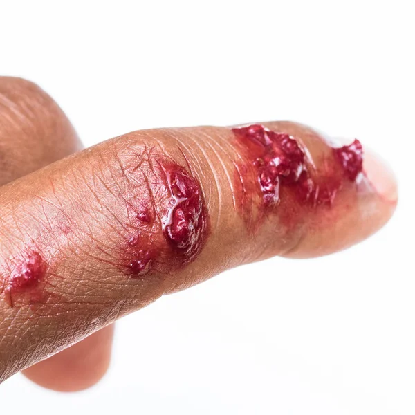 Zvláštní Efekt Krvavého Prstu — Stock fotografie