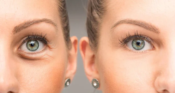 Przed Blepharoplastyce Bez Worków Oczy — Zdjęcie stockowe