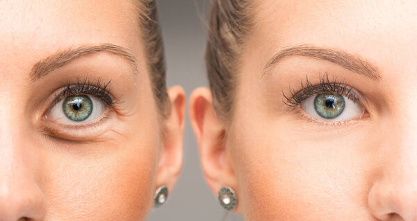 Before and after blepharoplasty with and without eyes bags