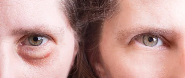 Ojos Antes Después Del Tratamiento Cosmético Con Sin Impermeabilización —  Fotos de Stock