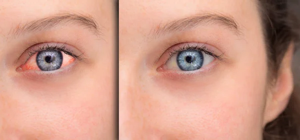 Vrouw Ogen Voor Oogdouche Vergelijking Met Een Rood Oog — Stockfoto