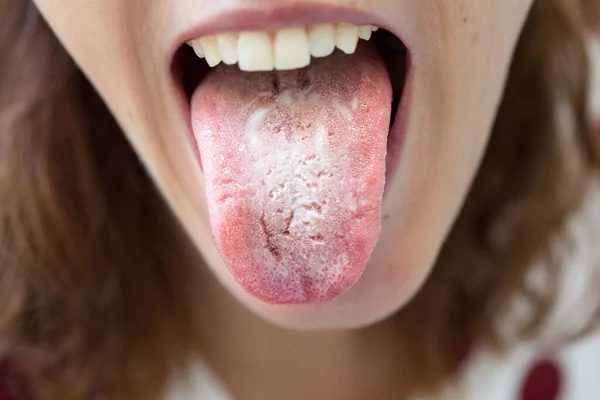 Woman with halitosis for candida albicans on tongue