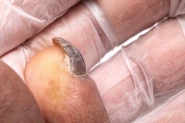 Mantar enfeksiyonu yüzünden küçük ayak tırnağı zarar görmüş. Arka planda steril eldivenli ele karşı karartılmış tırnak detayı. 