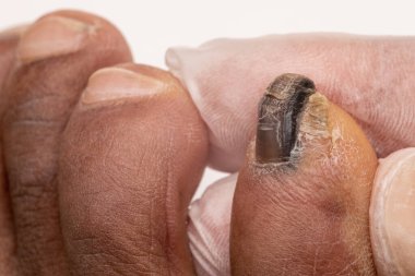 Closeup of little toe nail destructed by fungal infection. Blackened nail detail against hand in sterile glove on background.  clipart