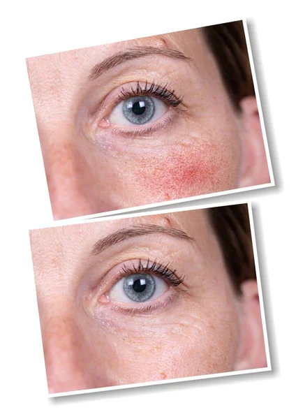 Collage Comparison Healthy Skin Skin Suffering Rosacea Visible Blood Vessels — Stock Photo, Image