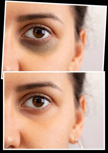 Collage Comparación Ojo Dama Joven Mostrando Antes Después Sufrir Ojeras — Foto de Stock