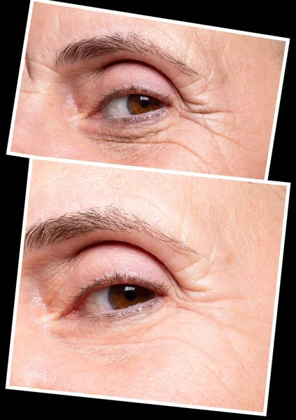 美容前と後のコラージュ比較 高齢女性の目のクローズアップビュー 健康とスキンケアの概念 — ストック写真