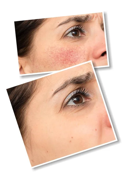 Collage Comparison Healthy Face Skin Face Skin Suffering Rosacea Visible — Stock Photo, Image