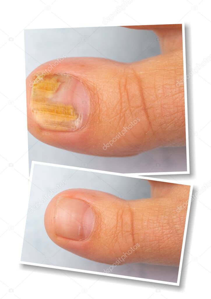 Collage comparison of before and after successful treatment for fungal infection on toe. Closeup of human toe suffering fungal infection causing yellowing of toenail. 