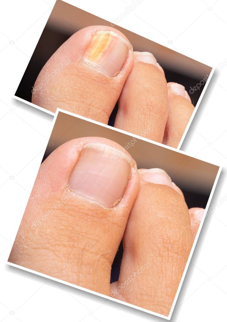 Collage comparison of before and after successful treatment for fungal infection. Big toe of caucasian adult suffering fungal infection causing yellowing of nail. 