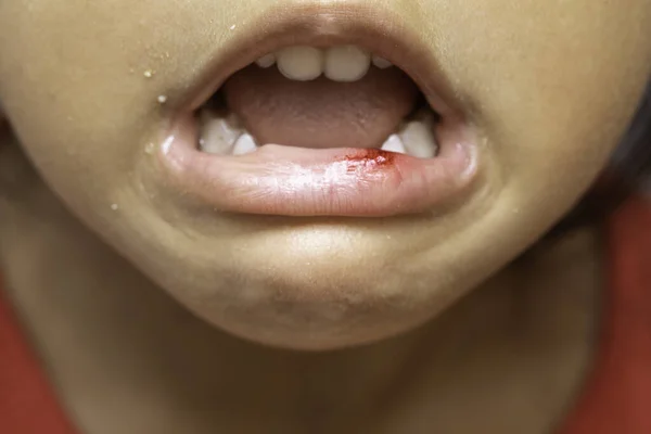 Enfant Bouche Ouverte Montrant Des Caries Carie Dentaire Gros Plan De Dents De Bebe Malsaines Medecine Dentaire Et Soins De Sante La Bouche Ouverte Du Patient Humain Montre Une Carie Dentaire Enfant Bouche Ouverte Montrant Des Caries Carie Dentaire Gros Plan De Dents De Bebe Malsaines Medecine Dentaire Et Soins De Sante La Bouche Ouverte Du Patient Humain Montre Une Carie Dentaire