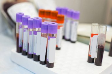 Farklı hastaların venöz kanlarıyla dolu renkli tıbbi test tüpleri ve bazı araştırmalar için hazır.. 