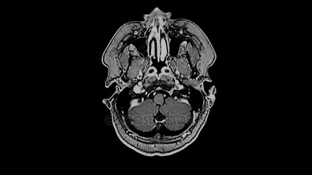 Kernspintomographie des Gehirns, Magnetresonanztomographie des Gehirns, Zeitraffer — Stockvideo