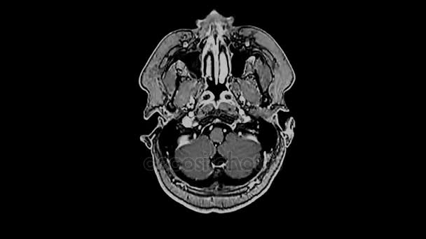 Resonancia magnética cerebral, resonancia magnética cerebral, lapso de tiempo — Vídeos de Stock