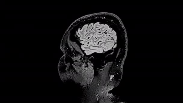 MRI脳のスキャン脳の磁気共鳴画像時間の経過 — ストック動画