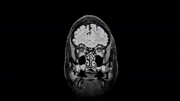 Mri brain scan, Magnetresonanztomographie eines Gehirns, ultra hd 4k, Zeitraffer — Stockvideo