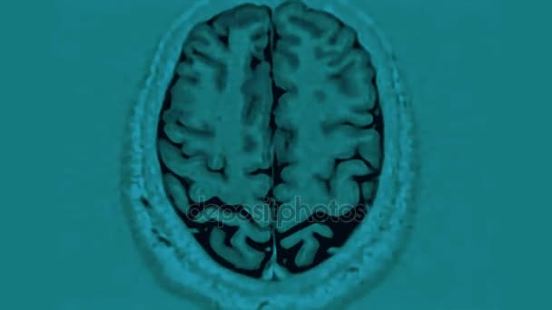 MRI sken mozku, magnetická rezonance mozku,, časový odstup — Stock video