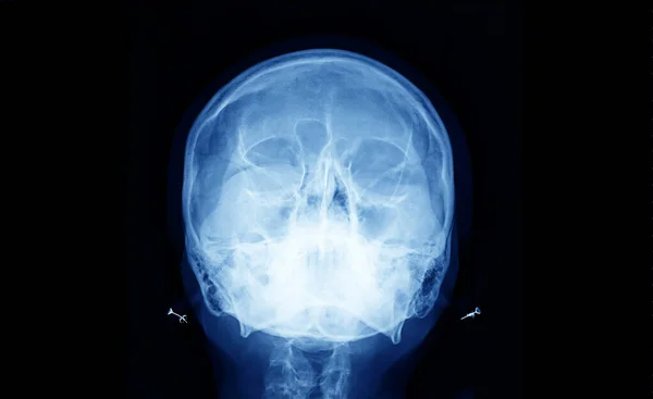Обычный Рентген Черепа Прямой Проекции Медицинская Диагностика Травматология Ортопедия Нейрохирургия — стоковое фото