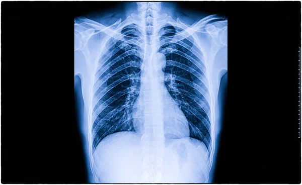 Рентгеновская Пленка Груди Человека — стоковое фото