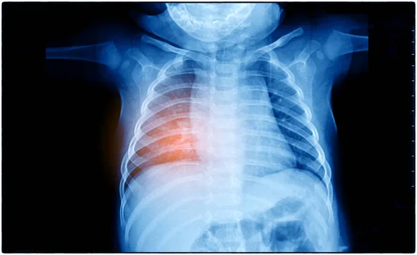 Рентгеновский Снимок Человеческой Груди Диагностики — стоковое фото