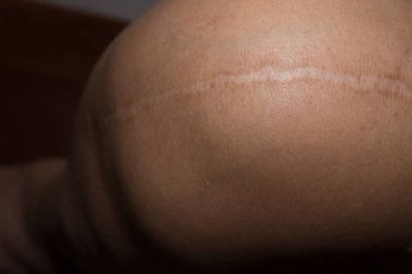 Bir tümör deri vücut portre resim