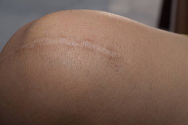 Bir tümör deri vücut portre resim