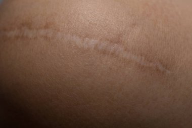 Bir tümör deri vücut portre resim