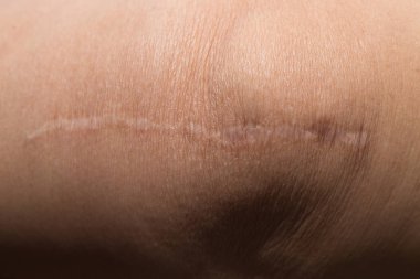 Bir tümör deri vücut portre resim