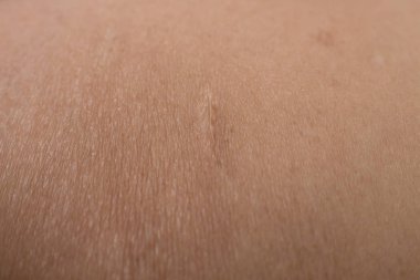 Bir tümör deri vücut portre resim