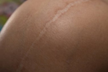 Bir tümör deri vücut portre resim