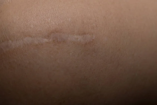 Ένα χηλοειδές σε δέρμα closeup εικόνα του σώματος — Φωτογραφία Αρχείου