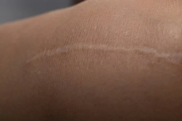 Keloid auf der Haut Nahaufnahme des Körpers — Stockfoto
