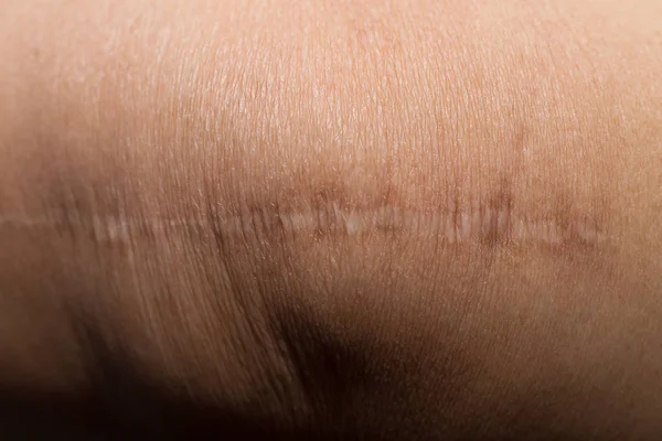 Un queloide en la piel Imagen de primer plano corporal — Foto de Stock